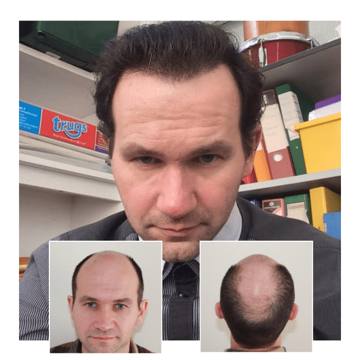 Restore Confidence: A Clear Path to Hair Restoration Options Restore Confidence: A Clear Path to Hair Restoration Options