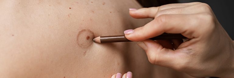 Natural-looking vitiligo concealing solutions in Dubai Natural-looking vitiligo concealing solutions in Dubai